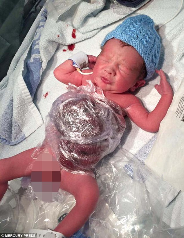 Bé Frankie Banyard mắc một dị tật bẩm sinh có tên gastroschisis, trong đó ruột ở ngoài cơ thể thông qua khiếm quyết ở một bên của dây rốn. Trong ảnh, các bác sĩ phải dùng màng bọc để quấn dây rốn bên ngoài cơ thể bé.