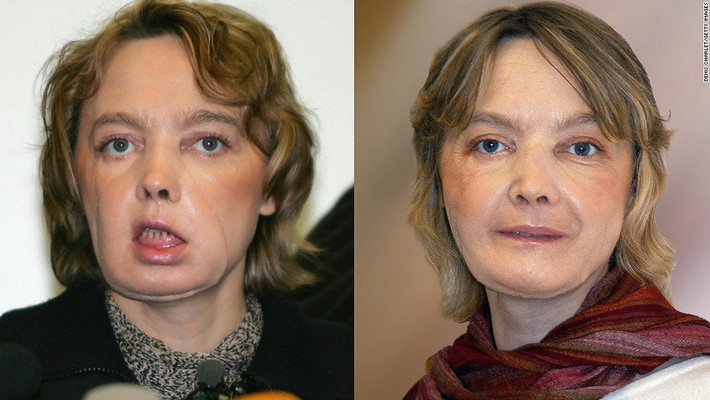 Isabelle Dinoire (39 tuổi - người Pháp) là người đầu tiên được ghép mặt năm 2005 sau khi bị một con chó tấn công và làm biến dạng khuôn mặt. Vài tháng sau đó, cô được các bác sĩ phẫu thuật để có gương mặt hoàn thiện hơn.