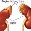 Suy tuyến thượng thận là tình trạng rối loạn trao đổi chất ở thận. Ảnh minh họa/Nguồn Internet