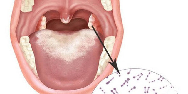 Cần làm gì khi tiếp xúc gần với bệnh nhân mắc bạch hầu? Can lam gi khi tiep xuc gan voi benh nhan mac bach hau?