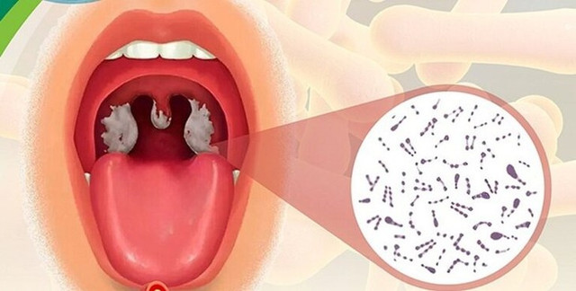Phân biệt bệnh bạch hầu họng với các chứng viêm họng, amidan Phan biet benh bach hau hong voi cac chung viem hong, amidan