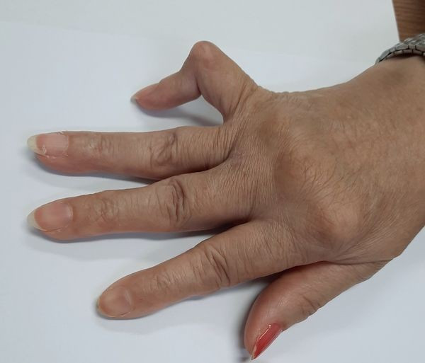 Các triệu chứng thường thấy của bệnh viêm khớp dạng thấp Cac trieu chung thuong thay cua benh viem khop dang thap