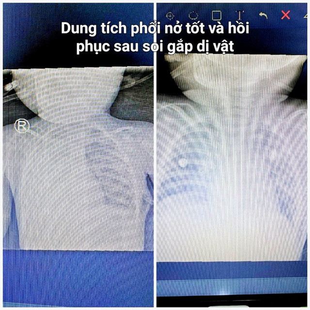 Bé 14 tháng tuổi bị biến chứng phổi do hóc hạt mãng cầu - Hình 3 Be 14 thang tuoi bi bien chung phoi do hoc hat mang cau-Hinh-3