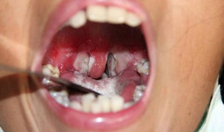 Triệu chứng của bệnh bạch hầu và cách chăm sóc người bệnh - Hình 2 Trieu chung cua benh bach hau va cach cham soc nguoi benh-Hinh-2