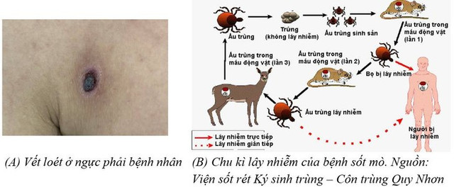 Suy đa tạng, lọc máu liên tục chỉ vì mò đốt Suy da tang, loc mau lien tuc chi vi mo dot
