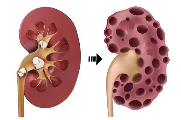 Dấu hiệu cảnh báo chức năng thận bị suy giảm Dau hieu canh bao chuc nang than bi suy giam