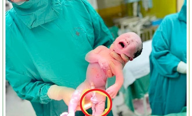 Dây rốn thắt nút, xử trí thế nào để an toàn thai nhi? Day ron that nut, xu tri the nao de an toan thai nhi?