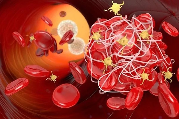 6 thói quen xấu làm tăng nguy cơ hình thành cục máu đông 6 thoi quen xau lam tang nguy co hinh thanh cuc mau dong