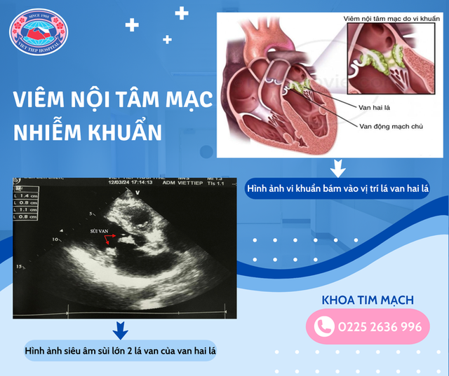 Mệt mỏi, sút cân, người đàn ông 47 tuổi phát hiện viêm nội tâm mạc Met moi, sut can, nguoi dan ong 47 tuoi phat hien viem noi tam mac