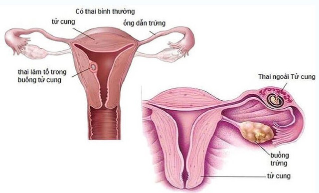Người phụ nữ 43 tuổi suýt tử vong vì tự phá thai tại nhà - Hình 2 Nguoi phu nu 43 tuoi suyt tu vong vi tu pha thai tai nha-Hinh-2