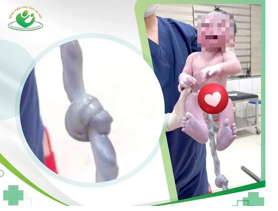 Bé bị dây rốn thắt nút chào đời bình an bằng sinh thường Be bi day ron that nut chao doi binh an bang sinh thuong