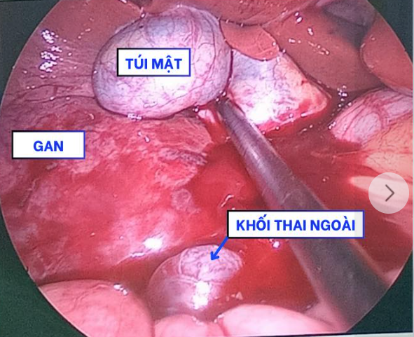 Người phụ nữ 27 tuổi chửa ngoài tử cung, thai làm tổ ở gan - Hình 2 Nguoi phu nu 27 tuoi chua ngoai tu cung, thai lam to o gan-Hinh-2