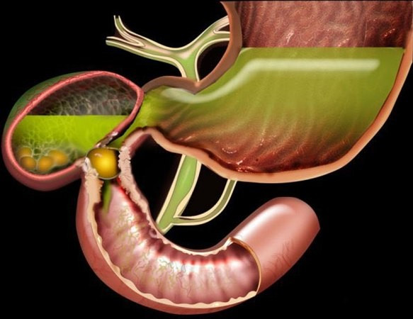 Cụ ông bị tắc ruột do chủ quan sỏi túi mật nhiều năm Cu ong bi tac ruot do chu quan soi tui mat nhieu nam