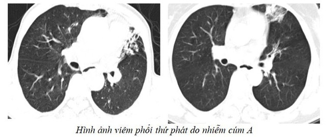 Cúm A tăng đột biến: Nhiều chùm ca bệnh, biến chứng nặng - Hình 2 Cum A tang dot bien: Nhieu chum ca benh, bien chung nang-Hinh-2