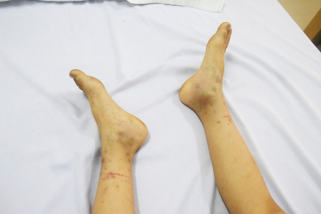 Bé 8 tuổi bị dị ứng viêm mao mạch, nguy hiểm tính mạng - Hình 2 Be 8 tuoi bi di ung viem mao mach, nguy hiem tinh mang-Hinh-2