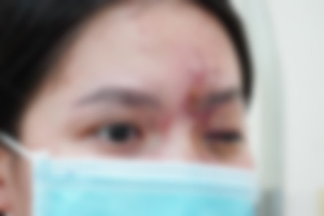 Cô gái trẻ mù mắt vì tiêm filler ở tiệm cắt tóc, gội đầu Co gai tre mu mat vi tiem filler o tiem cat toc, goi dau