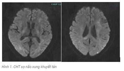 Tưởng đột quỵ, không ngờ viêm não tự miễn thể hiếm gặp Tuong dot quy, khong ngo viem nao tu mien the hiem gap