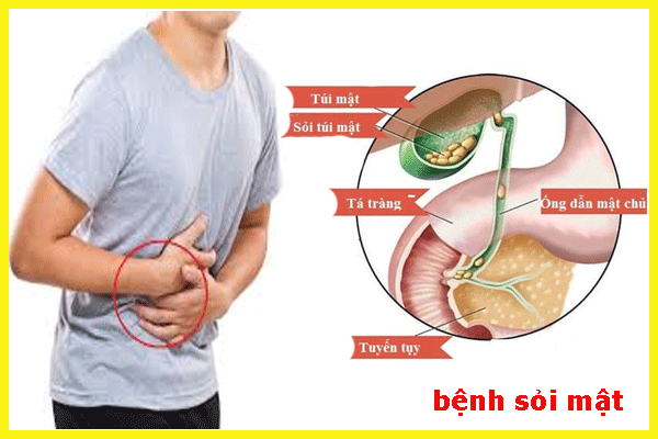 5 thói quen tưởng vô hại nhưng dễ gây sỏi mật 5 thoi quen tuong vo hai nhung de gay soi mat