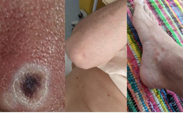 Ca đầu tiên mắc đậu mùa khỉ: ‘Tôi phát hiện bệnh khi đi khám vùng kín’ Ca dau tien mac dau mua khi: ‘Toi phat hien benh khi di kham vung kin’