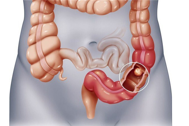 Dấu hiệu cảnh báo ung thư sớm, chớ nên chủ quan - Hình 2 Dau hieu canh bao ung thu som, cho nen chu quan-Hinh-2