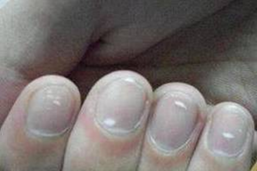 Tay xuất hiện dấu hiệu này, khám thận ngay kẻo hối không kịp - Hình 4 Tay xuat hien dau hieu nay, kham than ngay keo hoi khong kip-Hinh-4
