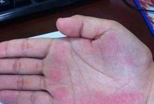 Tay xuất hiện dấu hiệu này, khám thận ngay kẻo hối không kịp - Hình 3 Tay xuat hien dau hieu nay, kham than ngay keo hoi khong kip-Hinh-3