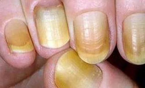 Tay xuất hiện dấu hiệu này, khám thận ngay kẻo hối không kịp Tay xuat hien dau hieu nay, kham than ngay keo hoi khong kip