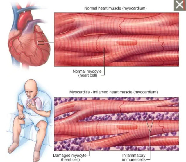 Nhóm người nào dễ mắc viêm cơ tim sau tiêm vắc xin Covid-19? Nhom nguoi nao de mac viem co tim sau tiem vac xin Covid-19?