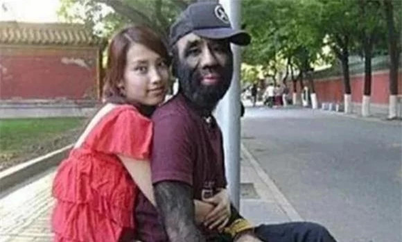 Cuộc sống hiện tại của 'cậu bé người vượn' ra sao? - Hình 4 Cuoc song hien tai cua 'cau be nguoi vuon' ra sao?-Hinh-4
