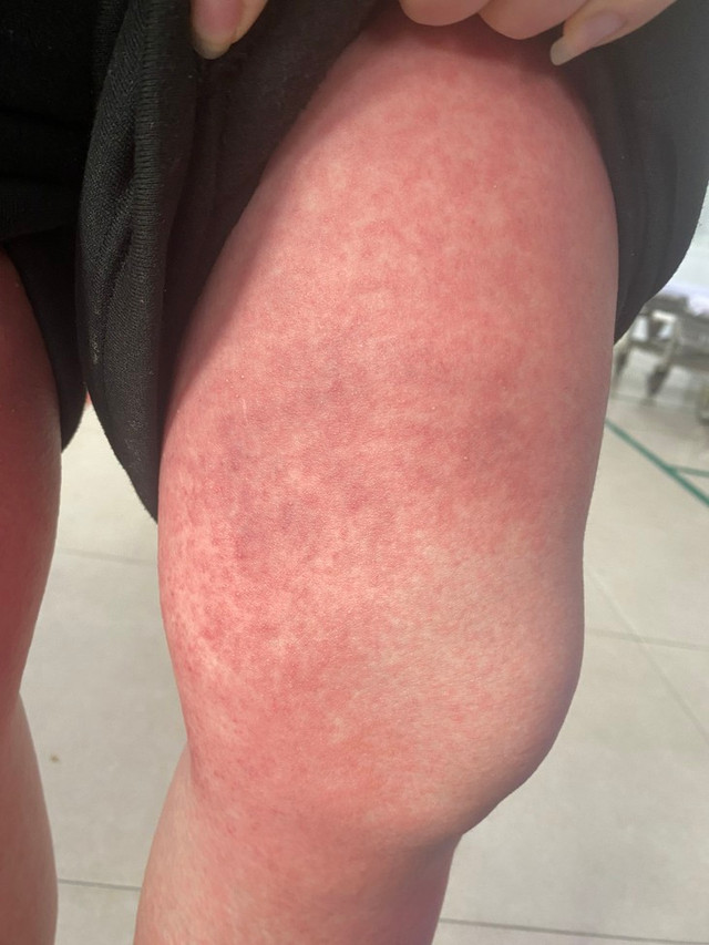 Bệnh nhi nổi mụn mủ toàn thân vì tự mua thuốc chữa long đờm Benh nhi noi mun mu toan than vi tu mua thuoc chua long dom