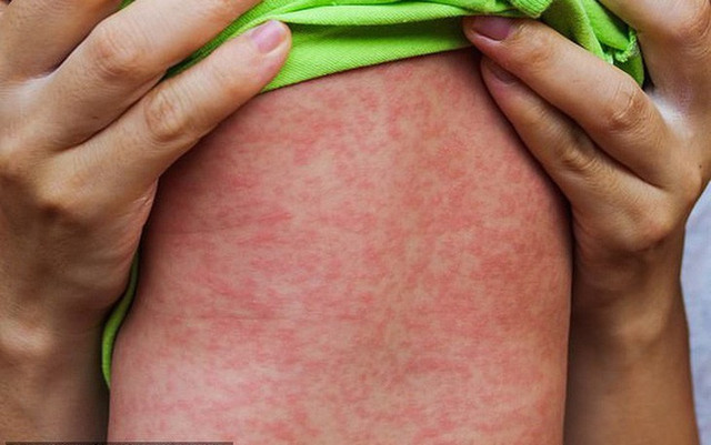 Ca mắc rubella vừa phát hiện ở Hà Nội đã tiêm vaccine Ca mac rubella vua phat hien o Ha Noi da tiem vaccine