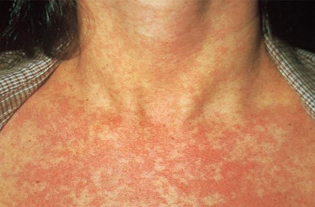Cách phân biệt bệnh sởi và rubella - Hình 2 Cach phan biet benh soi va rubella-Hinh-2