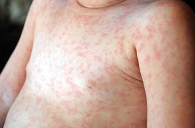 Cách phân biệt bệnh sởi và rubella Cach phan biet benh soi va rubella
