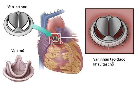 Dùng tiêu sợi huyết cứu bệnh nhân kẹt van tim nhân tạo Dung tieu soi huyet cuu benh nhan ket van tim nhan tao