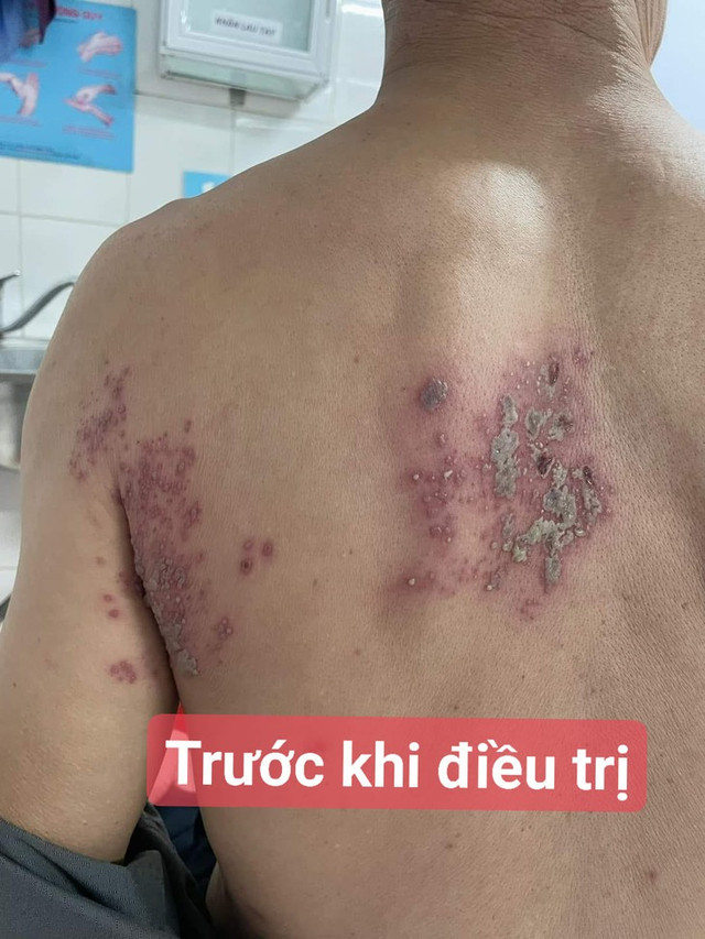 Liệt mặt, liệt chi, viêm não do zona thần kinh - Hình 2 Liet mat, liet chi, viem nao do zona than kinh-Hinh-2