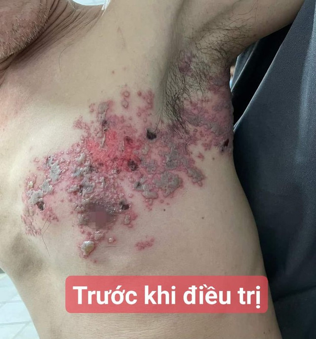 Liệt mặt, liệt chi, viêm não do zona thần kinh - Hình 3 Liet mat, liet chi, viem nao do zona than kinh-Hinh-3
