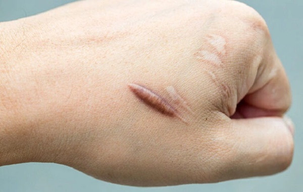 Vì sao ăn rau muống lại gây sẹo lồi? Vi sao an rau muong lai gay seo loi?