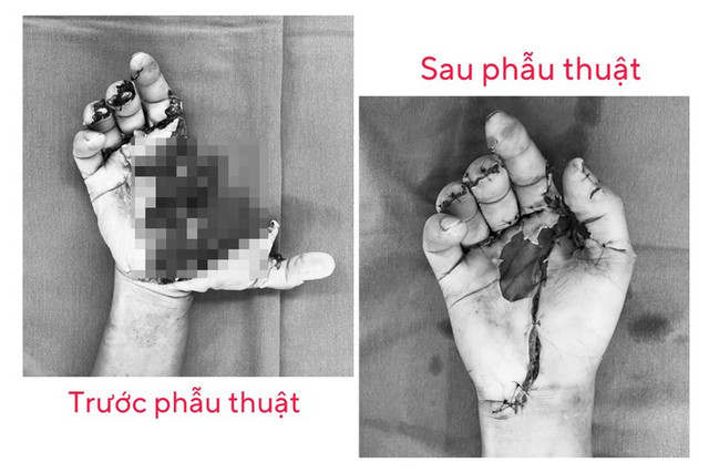1 ngày tiếp nhận 15 trường hợp bị chấn thương do pháo nổ 1 ngay tiep nhan 15 truong hop bi chan thuong do phao no