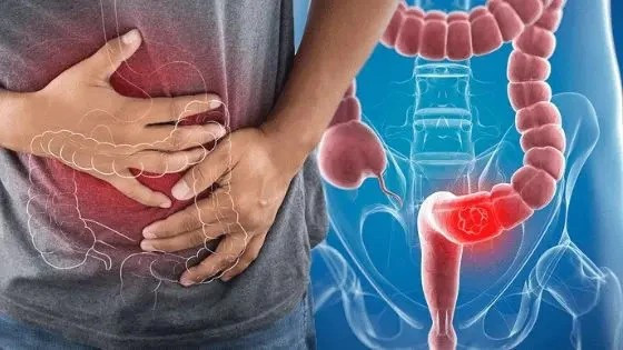 Dấu hiệu cảnh báo nguy cơ ung thư đại tràng Dau hieu canh bao nguy co ung thu dai trang