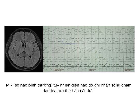 Điều trị thành công ca viêm não tự miễn hiếm gặp Dieu tri thanh cong ca viem nao tu mien hiem gap