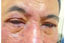 Phản ứng dị ứng thuốc gây tổn thương mắt nặng