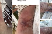 Người đàn ông 59 tuổi nhiễm vi khuẩn Vibrio vulnificus gây hoại tử da nhanh