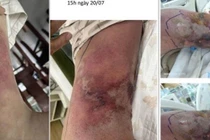 Người đàn ông 59 tuổi nhiễm vi khuẩn Vibrio vulnificus gây hoại tử da nhanh