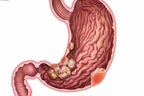 Ho kéo dài, người đàn ông phát hiện khối u mô đệm dạ dày, bệnh lý hiếm gặp