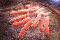 Lao màng bụng dễ nhầm lẫn với ung thư, cần chú ý triệu chứng sớm