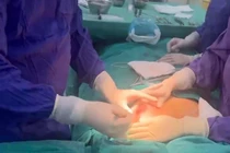 Ngực biến dạng, chảy mủ vì tiêm chất làm đầy từ 5 năm trước