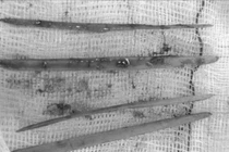 Nữ bệnh nhân cấp cứu vì nuốt tăm tre, nguy hiểm tính mạng