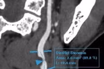 Người đàn ông mắc căn bệnh nguy hiểm do hút thuốc lá gần 30 năm