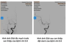 Trẻ 8 tuổi bị đột quỵ, cảnh báo bệnh ngày càng trẻ hoá