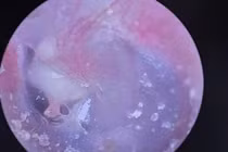 Bé trai 6 tuổi mắc bệnh cholesteatoma tai giữa phá hủy xương